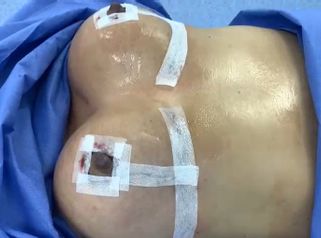 Levantamiento de senos - Dr. Yidio Jalaff Cirujano Plástico