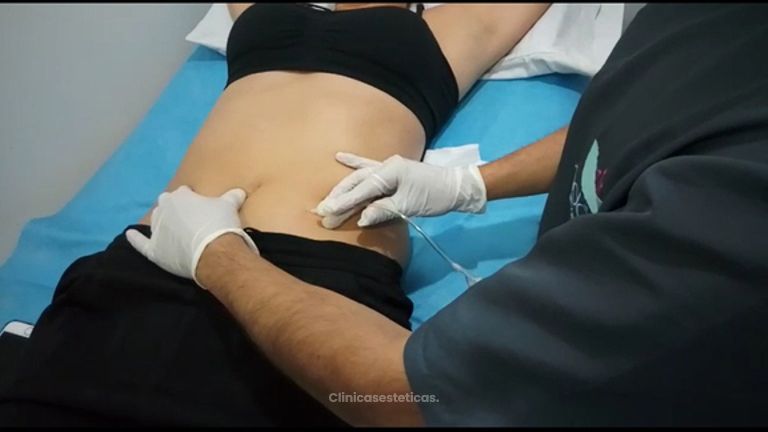 Carboxiterapia Enfocado en Reducción