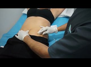 Carboxiterapia Enfocado en Reducción
