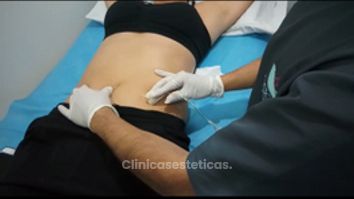 Carboxiterapia Enfocado en Reducción