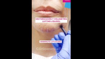 Lifting facial - Doctora Alexandra Mora