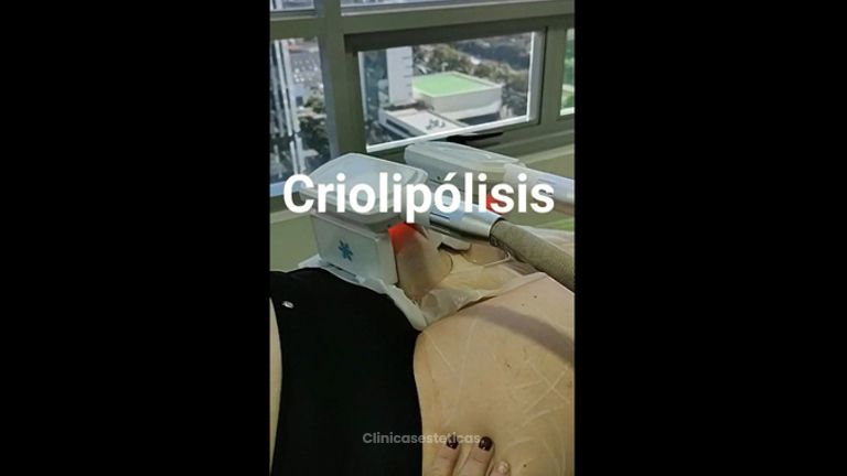 Criolipólisis - Kairos Salud Integral