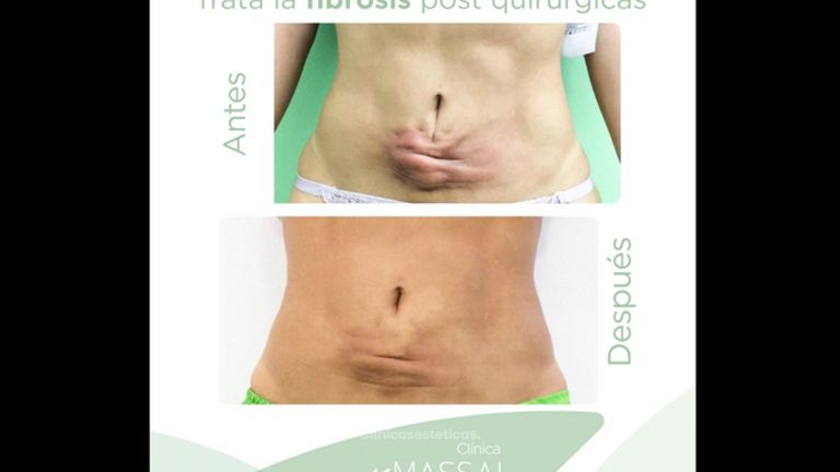 Fibrosis postquirúrgicas - Massai Clínica