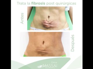 Fibrosis postquirúrgicas - Massai Clínica