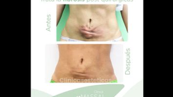Fibrosis postquirúrgicas - Massai Clínica