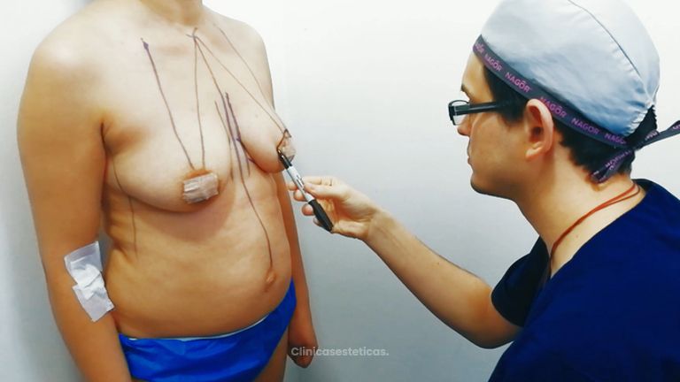 Mamoplastia de aumento - Dr. Johnatan L De Guevara