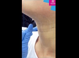 Cirugía de papada - Doctora Alexandra Mora