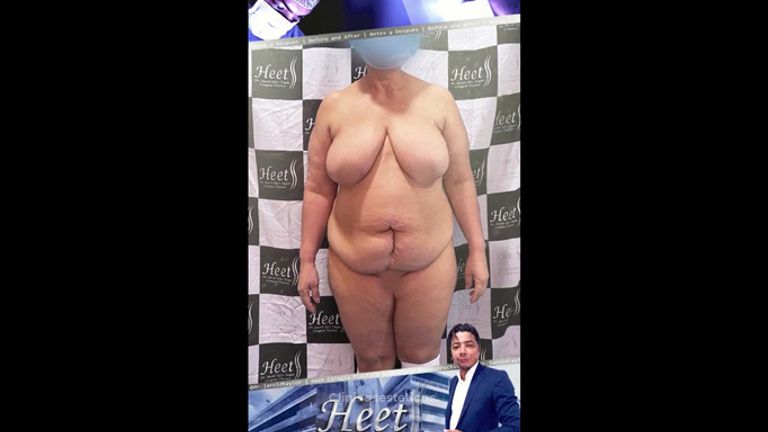 Lipoescultura - Dr. Jarold Effer Taylor