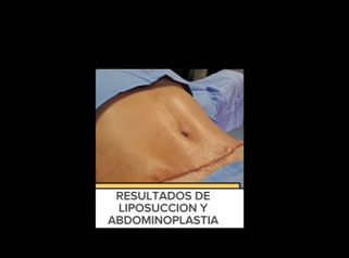 Abdominoplastia - Dr. Milton Rincón Carranza