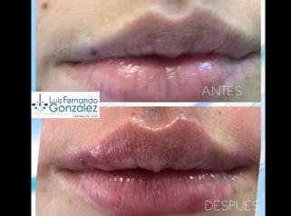 Aumento de labios