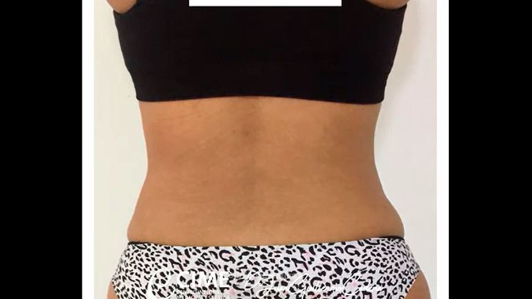 Antes y después en lipoescultura