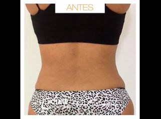 Antes y después en lipoescultura