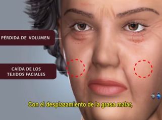 Elimina los surcos de tu rostro