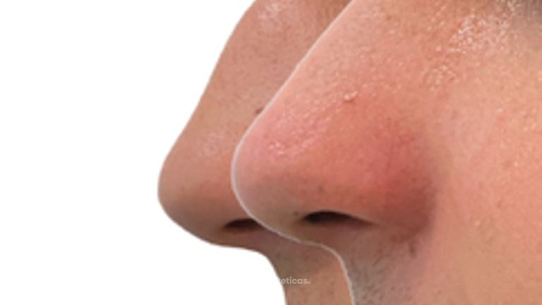 Rinoplastia en hombres - Doctora Alexandra Mora