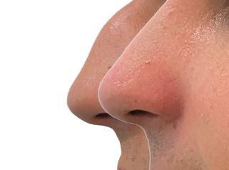 Rinoplastia en hombres - Doctora Alexandra Mora