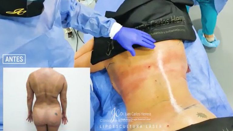 Lipoescultura - Dr. Juan Carlos Herrera P.