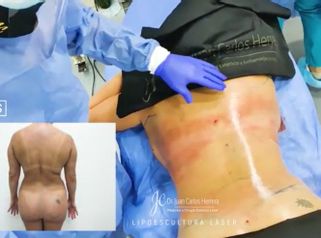 Lipoescultura - Dr. Juan Carlos Herrera P.