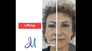 Lifting facial - Dr. José Miguel Sandoval Rodríguez