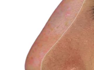 Rinoplastia - Doctora Alexandra Mora