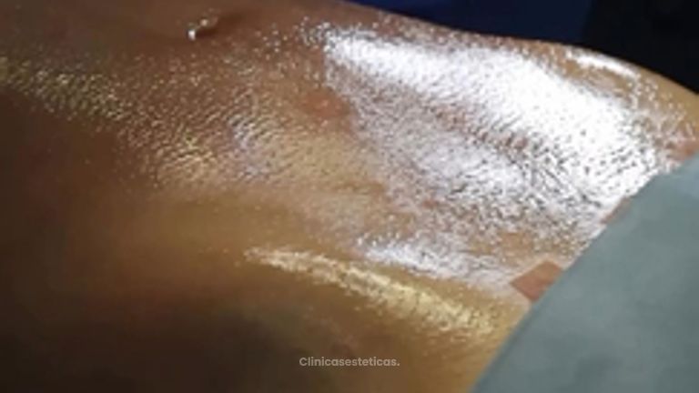 Lipoescultura HD - Clinica Vivir