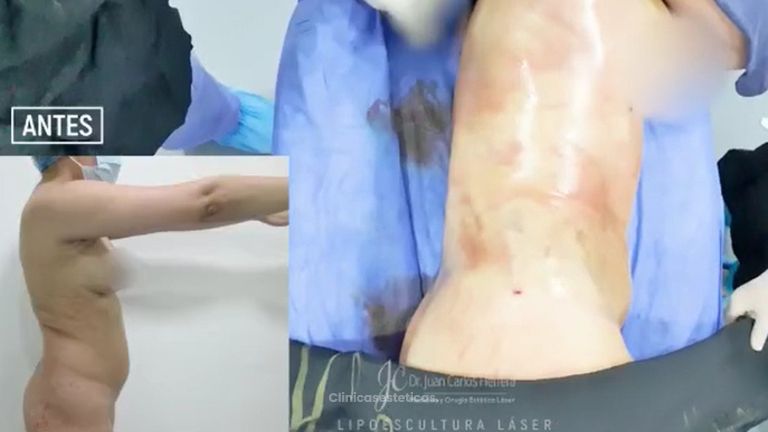 Lipoescultura - Dr. Juan Carlos Herrera P.