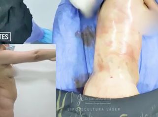 Lipoescultura - Dr. Juan Carlos Herrera P.