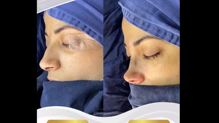 Rinoplastia - Dr. Jaime Pachón