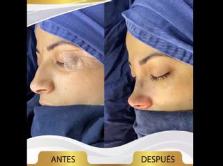Rinoplastia - Dr. Jaime Pachón