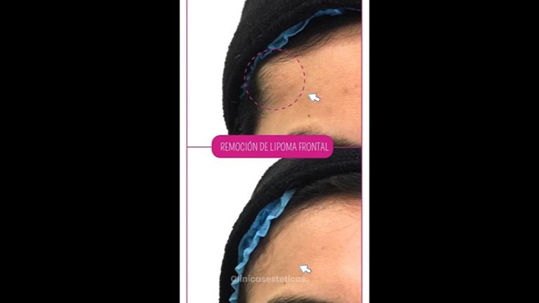 Remoción lipoma frontal - Doctora Alexandra Mora