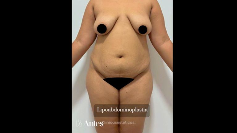 Abdominoplastia - Dr. Reinel Mesa