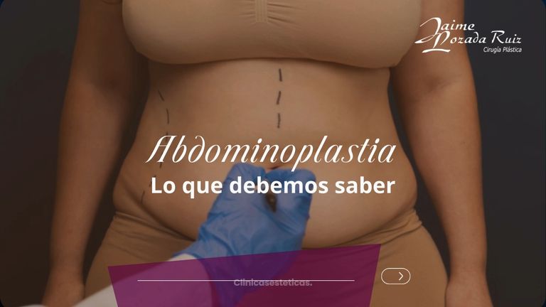 Abdominoplastia lo que debemos saber - Dr. Jaime Lozada Ruiz