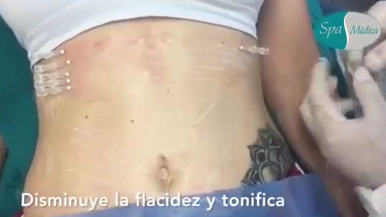 Procedimiento en abdomen de Hilos tensores re-absorbibles