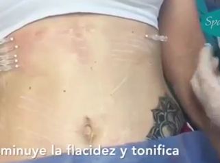 Procedimiento en abdomen de Hilos tensores re-absorbibles