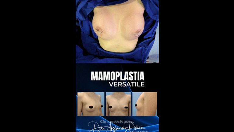Mamoplastia de aumento - Dr. Alejandro Deniz Martínez