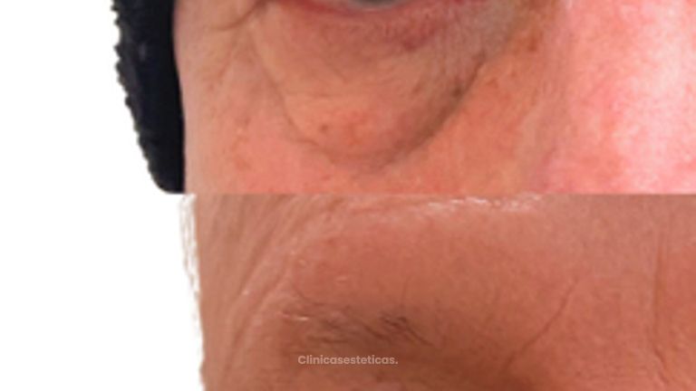 Blefaroplastia Masculina -Doctora Alexandra Mora