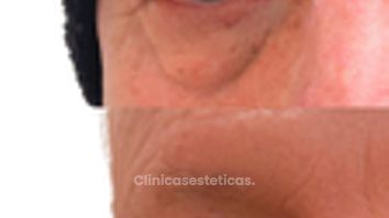 Blefaroplastia Masculina -Doctora Alexandra Mora
