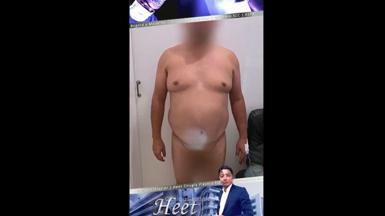 Liposucción - Dr. Jarold Effer Taylor