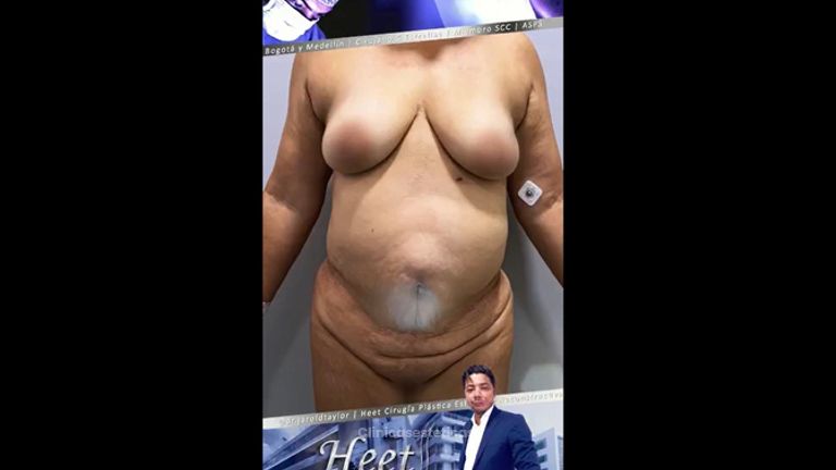Liposucción - Dr. Jarold Effer Taylor