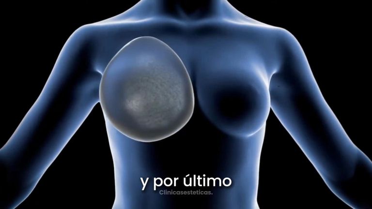 Recambio de implantes - Dr. Juan Canencio
