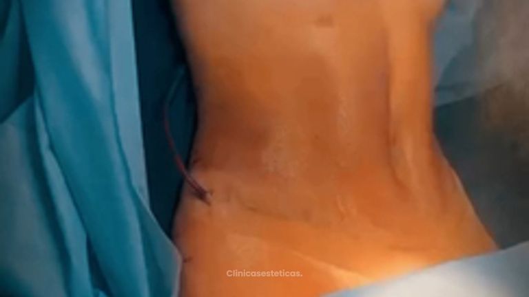 Lipo Abdominoplastia + mamoplastia de aumento - Clinica Vivir