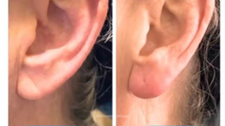 👂 Tratamiento de lóbulos auriculares