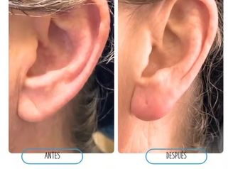 👂 Tratamiento de lóbulos auriculares