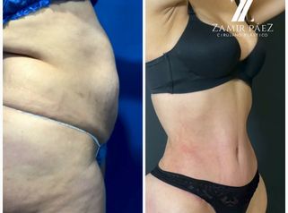 Abdominoplastia - Dr. Zamir Páez