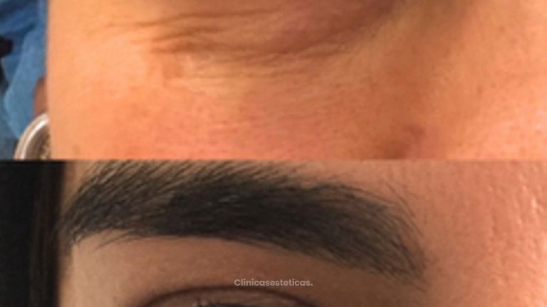 Tratamiento de Ojeras - Doctora Alexandra Mora