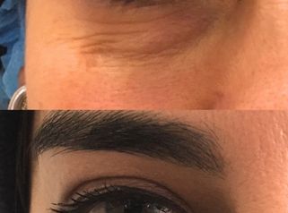 Tratamiento de Ojeras - Doctora Alexandra Mora