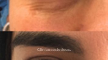 Tratamiento de Ojeras - Doctora Alexandra Mora
