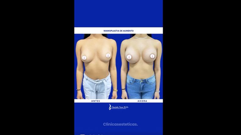 Mamoplastia de Aumento - Dra. Daniela Stephania Vaca Grisales