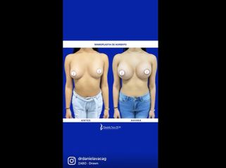 Mamoplastia de Aumento - Dra. Daniela Stephania Vaca Grisales