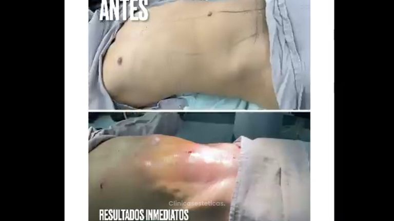 Liposucción - Dr. Hugo Javier Mejía Cuello