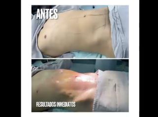 Liposucción - Dr. Hugo Javier Mejía Cuello